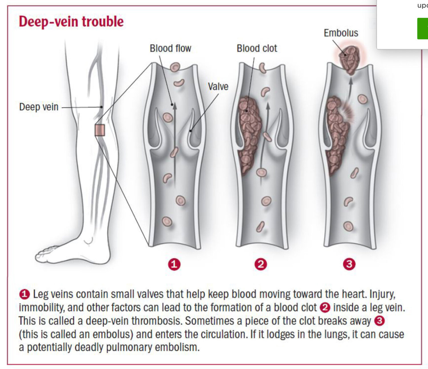 Deep-Vein-Thrombosis.jpg