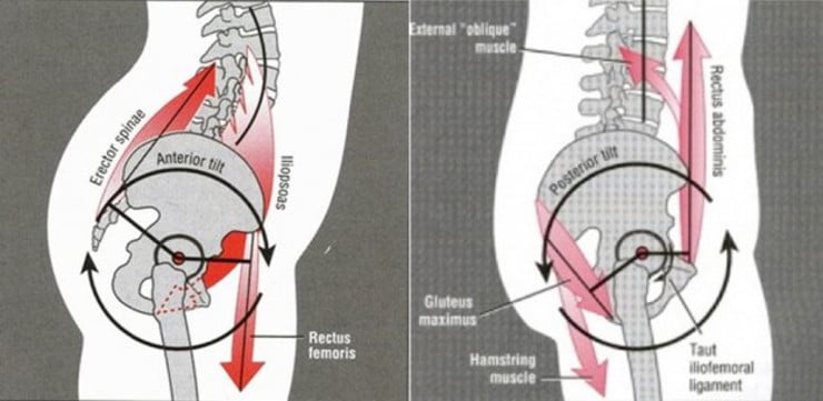 anteriorpelvictilt.jpg