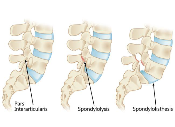 Spondylolisthesis in Athletes: Treatment and Return to Sports
